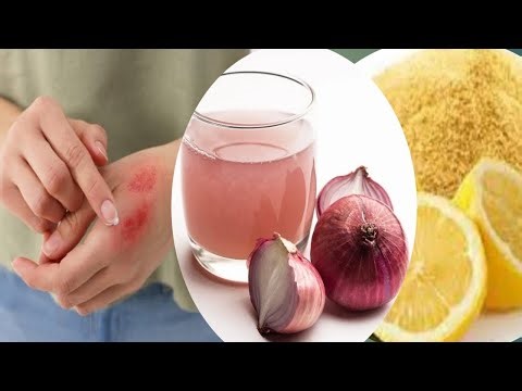 Kitchen Burn Scars]: DIY Soothing & Fading! ?