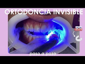 Alineadores invisibles. Proceso de colocación de ataches en clínica