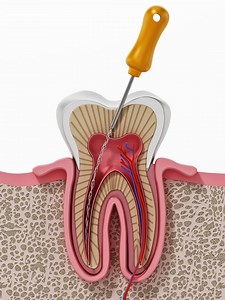 170K views · 766 reactions | This is how your dentist performs Root canal treatment. #Dentist | Doctor ASKY | Facebook