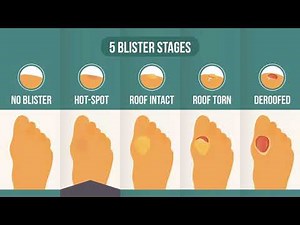 Hot Spot On Foot: The 2nd Stage In The 5-Stage Blister Process [Theory]