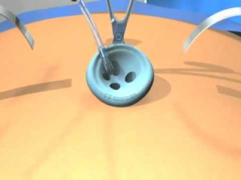 Single Incision Laparoscopic Surgery SILS