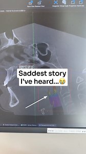 The CPAP blew off his face because it couldn't get air into the airway.... THAT is how bad his sleep apnea was. Look what we found on the Cone Beam CT scan! In this video I'll walk you through the dental procedure we are going to do for him to help him so that he can energy to play with his kids again. #lifechanging #airway #dentalhealth #cpap #sleepapnea #sadstory #dentalstory #dentist #biologicaldentist #functionaldentist #holisticdentist #mouth #conebeamctscan #oralhealth #cantbreathe #breath