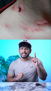 Skin tags are NOT moles. And no—they’re not just harmless growths you’re born with. What are Skin Tags? They are small, soft, flesh-colored growths that usually appear on: • Neck • Armpits • Eyelids • Under the breasts • Groin folds ⚠️ What causes them? No, it’s not due to sweat, friction, or allergies. In most cases, skin tags are a sign of insulin resistance — a condition where your body doesn’t respond well to insulin due to: • Excess sugar & refined carbs • Processed foods • Inactivity • Chr