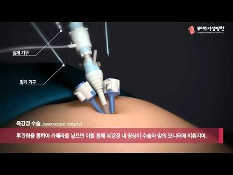 [포미즈하이푸] 자궁근종치료법 - 복강경을 이용한 자궁근종절제술