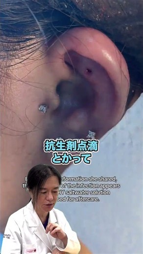 【軟骨のピアスの腫れ】パンパンに化膿してピアスが埋まる！受診される前にシリコンリング治療の可否を確認しよう！