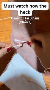 14K views · 52 reactions |  You won't believe what came out of this one... #pimplepop #satisfying | Pimple Popping | Facebook