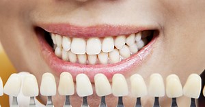 Is Teeth Whitening Safe? Sensitivity, Products, and Side Effects
