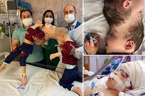 Conjoined twins born with fused brains separated after 27-hour surgery