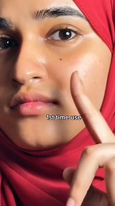 Easy acne solution ✨ | skinpro