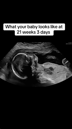 Anatomy scan 21 weeks #anatomyscan #21weeks #21weekspregnant #pregnancyjourney #ultrasound