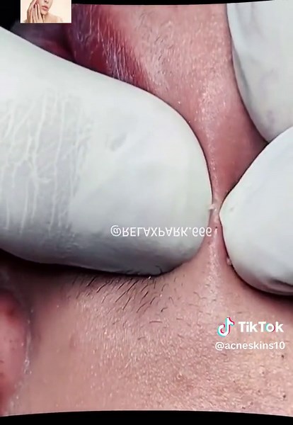 #squeeze #squeezeyuk #acne #pimple #pimplepop #blackhead #satisfying #foryoupage 115