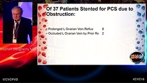 Pelvic Varices: I Stent Iliac Compression First Because…