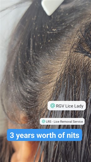 ⚠️ TRIGGER WARNING: This is what 3 years of a level 5 lice infestation looks like. ​This is a real bag from a recent client who was tired of the endless cycle of frustration. I hear it all the time: parents try every over-the-counter product, but the lice just keep coming back. That's because those products only kill the live bugs—they don't get the nits (the eggs). ​You can see the result here: a major infestation that was still active. The only way to truly break the cycle is with thorough, ma