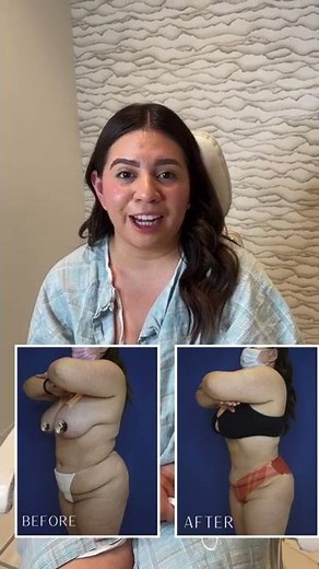 Liposuction of Flanks and Abdomen Results - Patient Testimony | Dr. Saul Lahijani