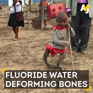 This 6-year-old boy's bones are deformed because of what he drinks: | AJ