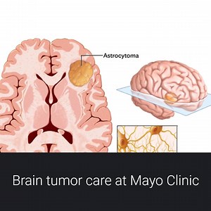 At Mayo Clinic, we use innovative technology to treat brain tumors once considered inoperable. Mayo Clinic in Arizona, a National Cancer Institute (NCI) designated Comprehensive Cancer Center, has been ranked #1 in the state of Arizona for Neurology and Neurosurgery, and Cancer care. | Mayo Clinic