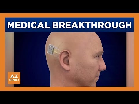 Tucson patients receive first fully internal cochlear implants