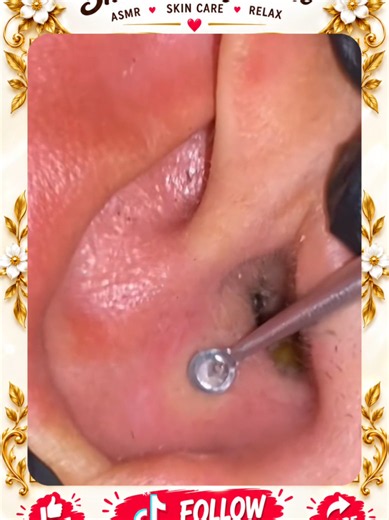 Deep Blackhead Extraction & Satisfying Popping | Wait for the most satisfying pop 😳🫣 You won’t believe what comes out! #pimplepoppersatisfying #Acne #pimple #Blackhead #Satisfying