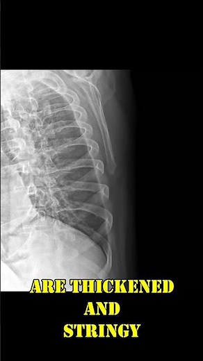 Spotting Chronic Bronchitis on CXR Radiology Short