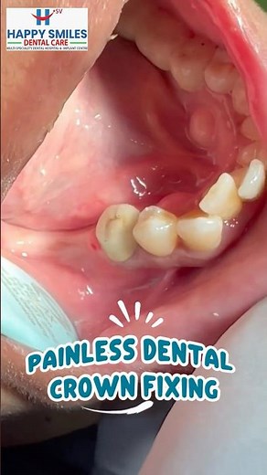 Painless Dental Cap Fixing || Best Dental Clinic || Happy Smiles