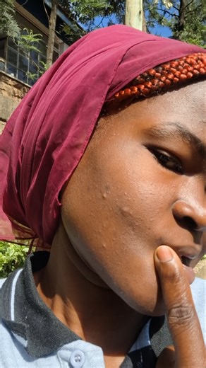 what can finish this pimples on my face🥺😭