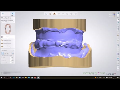 Denture Design with Gnathometer CAD