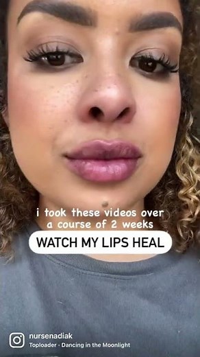 Lip filler healing process