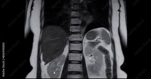 Upper abdominal MRI displays normal anatomy and organ structures, serving as a reference for future evaluations and medical examinations.