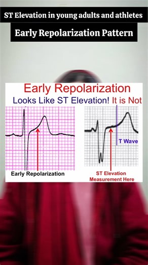 The Doctor | Health Educator 🩺 on Instagram: "Early repolarization in ECG ECG par ST elevation dikhte hi sab ke zehan me ek hi khayal aata hai — Heart attack! 💔 Lekin agar patient bilkul theek lag raha ho, chest pain bhi nahi, troponin normal… to phir kya ye sach me MI hai? 🤔 Yahin par aata hai Early Repolarization Pattern — ek benign finding jo zyada tar young healthy adults ya athletes me dekhi jati hai. 🏋️‍♂️ ECG par ye kaise pehchaanein? 👉 Mild ST elevation, usually V2–V5 leads me 👉 No