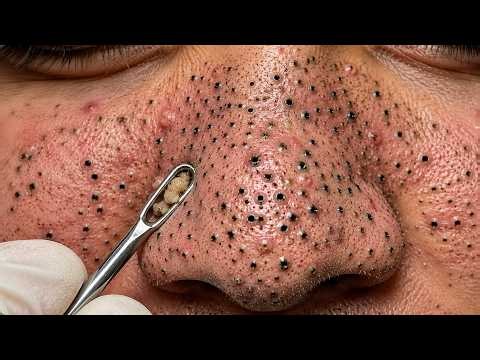 How I Relax Whit Most Satisfying Blackhead Removal You'll Ever Watch – Deep Pore Cleanup!