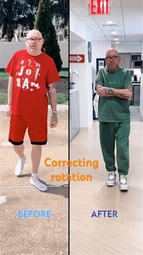 Correcting femur malrotation and shortening by twisting around a lengthening nail