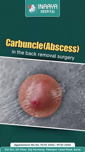 🩺 Expert Carbuncle (Abscess) Removal Surgery at Inaaya Hospital!