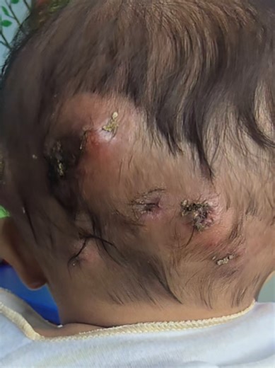 Ka dhintoh Infeksi Kulit banne alergi tellor otabha parloh gante susu. Dhaddhi ta' parloh e tang-pantang. Nak-kanak butoh gizi se bhagus ghabay pertumbuhan. #impetigo #carbuncle #skininfection #dokterspesialisanakpamekasan #dokteranakpamekasan