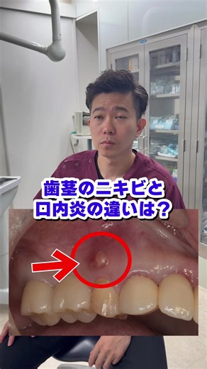 口内炎とサイナストラクト（ニキビ）の違いとは？症状と見分け方
