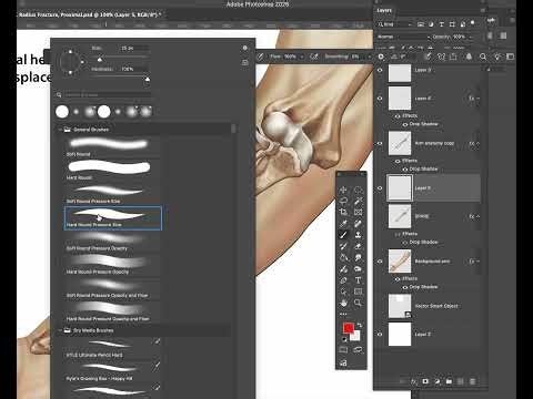 How to Add a Radial Head Fracture with Displacement