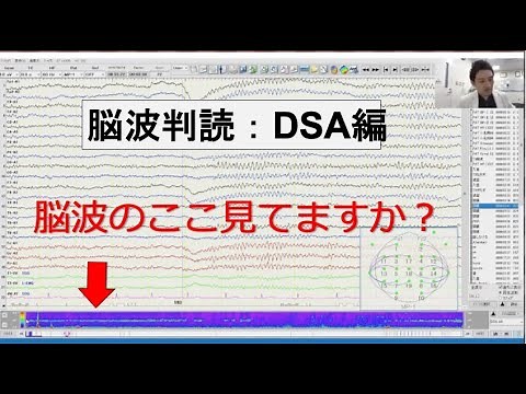 脳波判読ウェブセミナー： DSAの見方