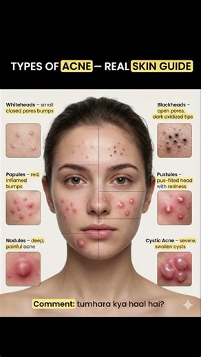 Har pimple same nahi hota ⚠️Real skin guide 💛#skincare #acne #glowingskin #skin #attractiveface