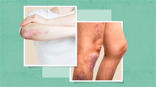 Psoriasis on the Knees and Elbows: How to Treat Flares