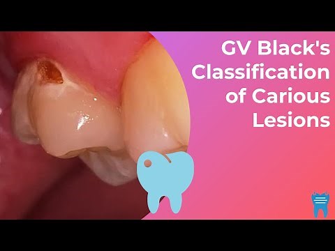 How to classify dental caries | GV Black's Classification of Caries