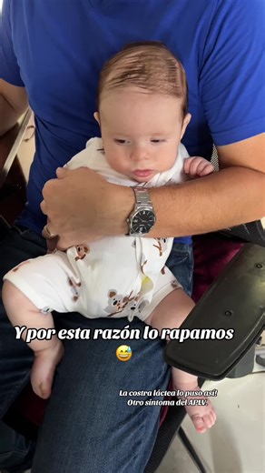 Me estoy quedando pelón - La costra láctea y otros síntomas en bebés