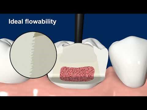 VOCO VisCalor bulk thermoviscous bulk fill composite