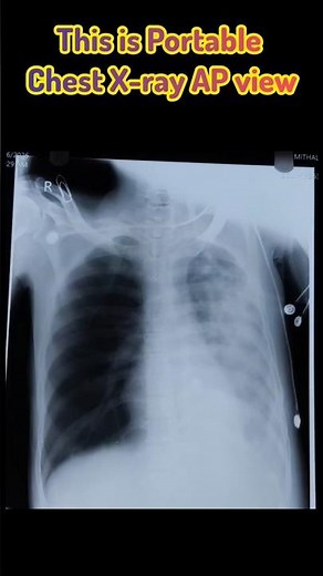 Portable Chest X-ray (AP View) Explained 🩻#‪@SmartMedicalKnowledge‬