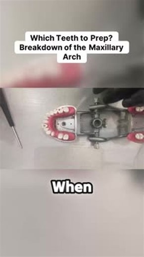 ADEX Academy on Instagram: "The upper arch is the epicenter for mastering endodontic and prosthodontic procedures! This quick look pinpoints the exact work areas: bridge prep across teeth #3, #4, and #5, essential endo access and obturation at #8, crown prep on #9, and a molar access point at #14. The secret to perfecting technique is revealed—many areas feature a simple screw you can remove, unlocking endless opportunities to practice those critical preps over and over again. A must-see for any