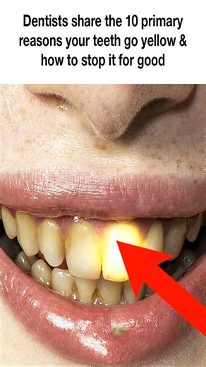 Before you spend money on whitening kits, read this — dentists explain the top 10 reasons teeth turn yellow and the simple ways to stop it. | Health Tips Tricks