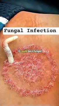 Fungal Infection | Symptoms, Mistakes & Right Treatment