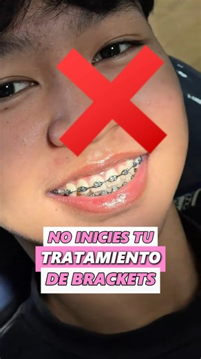 SONRÍE CUENCA on Instagram: "❌ NO inicies tu tratamiento de BRACKETS ❌ sin conocer esta promoción 😁BRACKETS en CUENCA, $20 mensuales INCLUYE: 👉 Instalación superior e inferior 👉Eliges el color de ligas que más te guste 👉Guiado por especialistas 📍Cuenca, Av de las Américas y Miguel Cabello Balboa ( Edificio amarillo diagonal a la entrada a Misicata) 📲Ingresa al link de nuestro perfil para agendar #SONRIECUENCA #cuenca #bracketscuenca #ortodoncia #bracketsmetalicos"