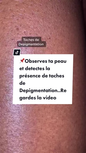 Taches de de pigmentation #depigmentation #melanine #tachededepigmentation