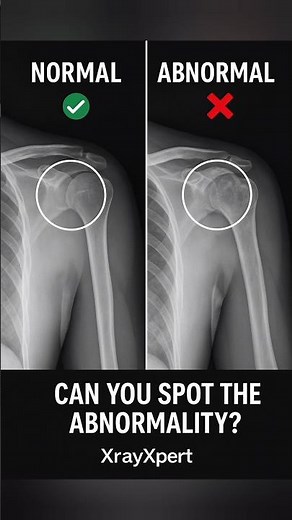 Normal vs Abnormal Shoulder X-rayक्या आप पहचान सकते हैं किसमें fracture है? 👀 XrayXpert#XrayXpert #