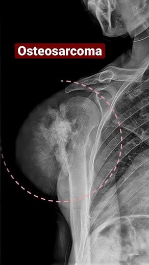 Osteosarcoma of the humerus 🦴🦴 #xray #bones #medical