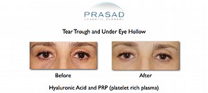Hollow Eyes Treatments - Fillers, PRP & Tear Trough Implants